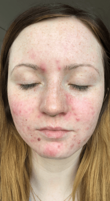 Formelskin Image