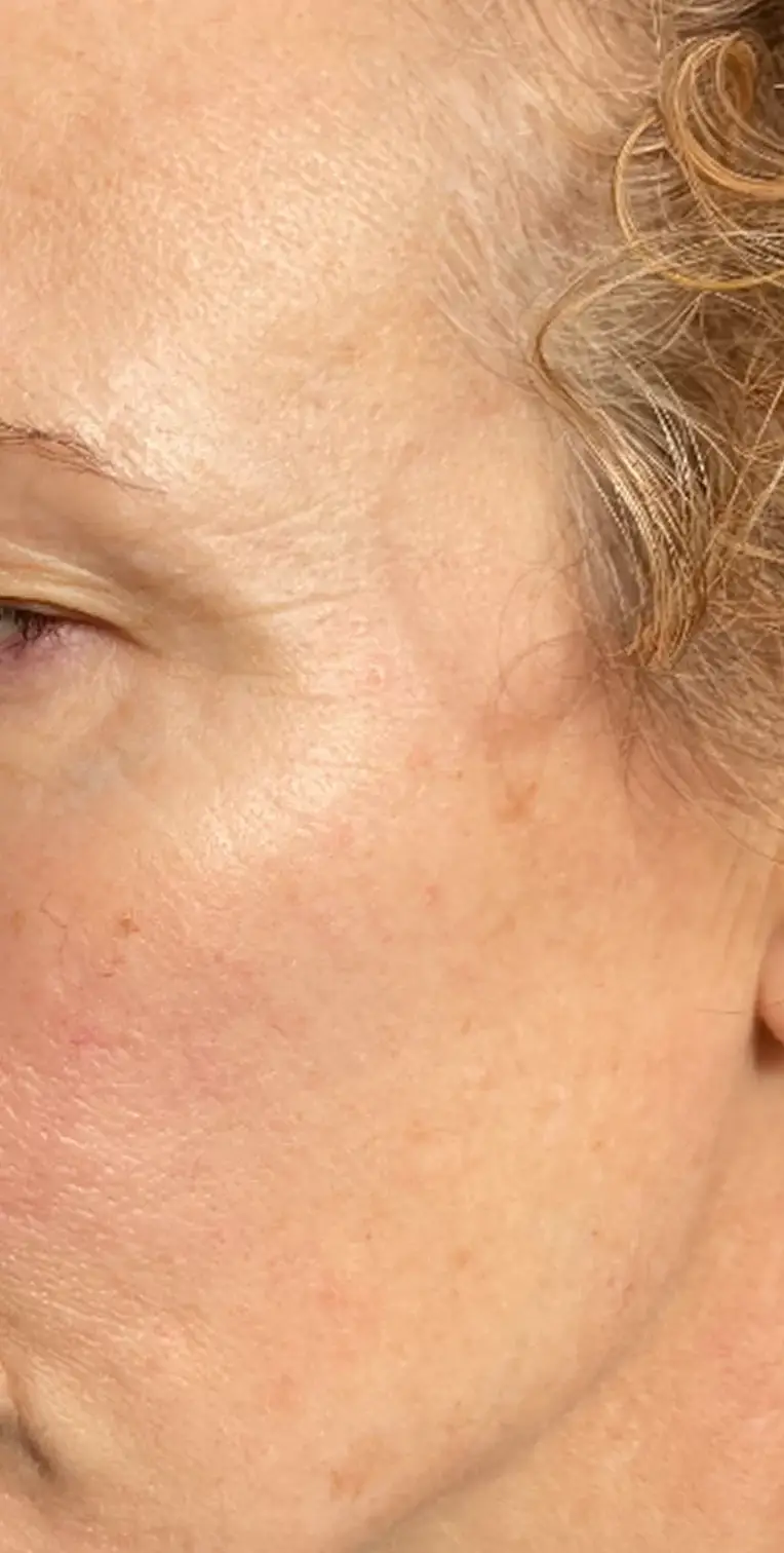 Formelskin Image