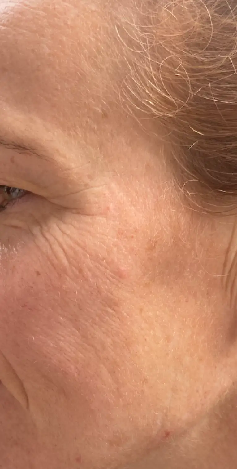 Formelskin Image