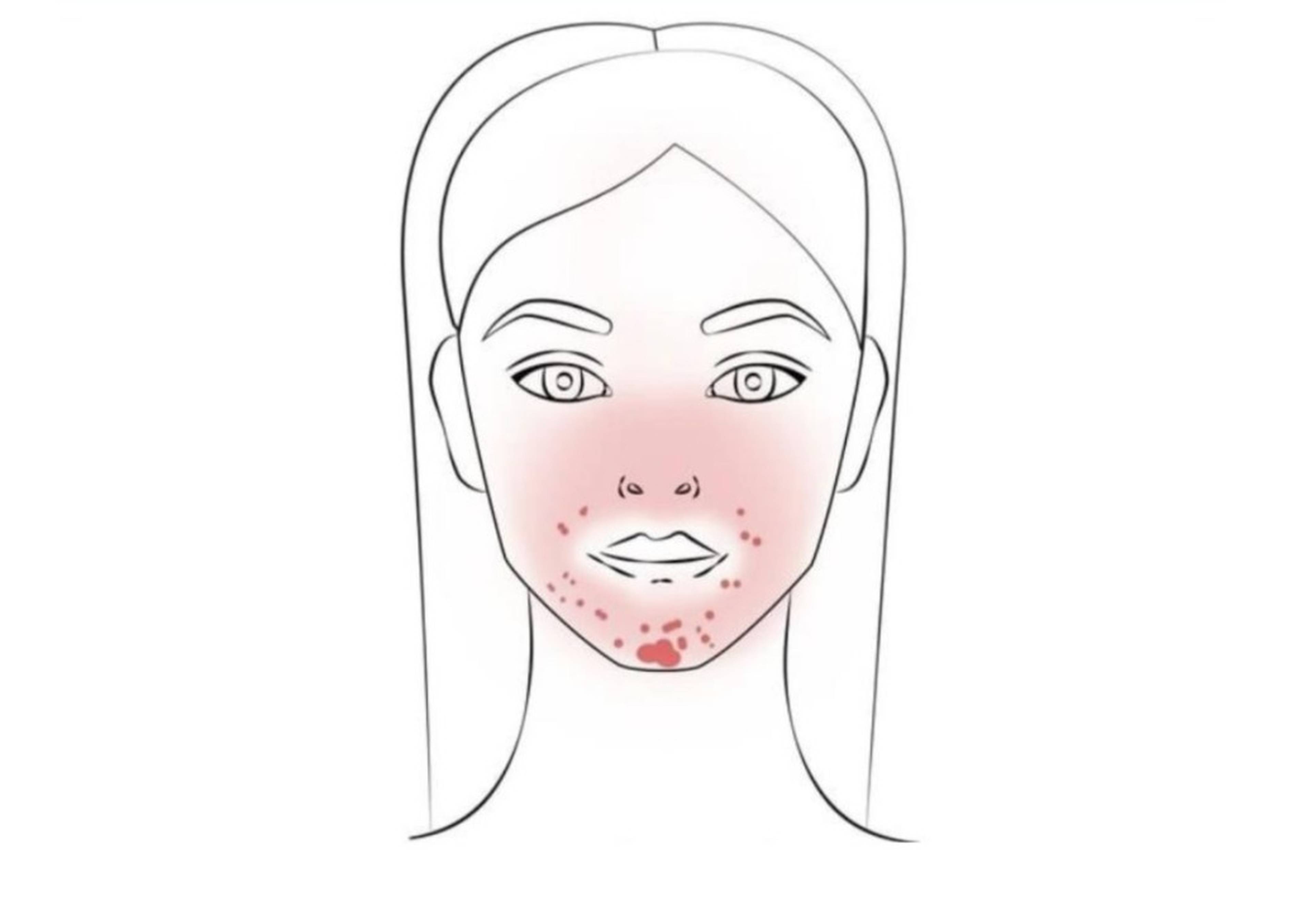 Abbildung periorale Dermatitis